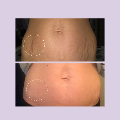 Crema Reafirmante GoPure — Reduce Estrías Visiblemente en 4 Semanas