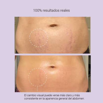 Crema Reafirmante GoPure — Reduce Estrías Visiblemente en 4 Semanas